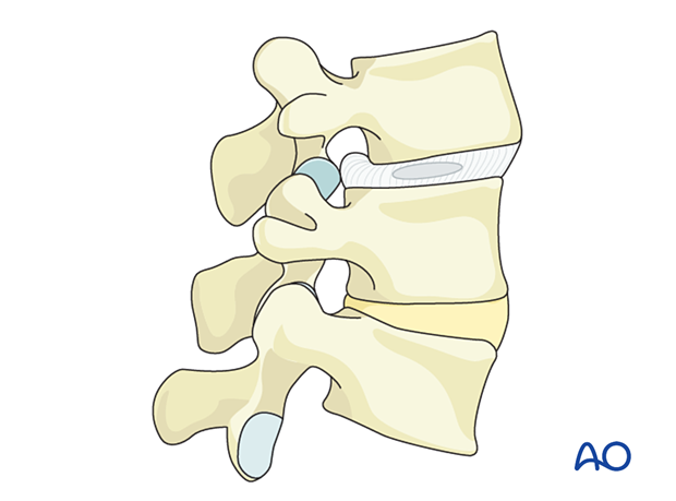 L3–L4 level with Spondylolisthesis with foraminal stenosis and degenerative disc disease