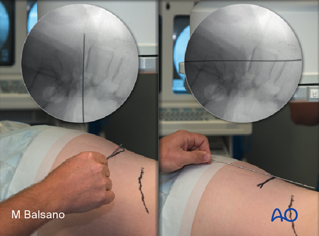 During Lateral lumbar interbody fusion (LLIF), it is helpful to use a localizer on the skin to identify the level and the incision position