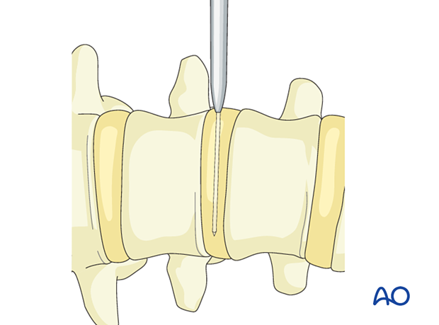 During Lateral lumbar interbody fusion (LLIF), a K-wire is positioned inside the tube