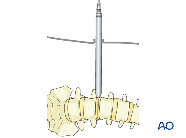 A series of dilators are used to increase the working area during Lateral lumbar interbody fusion (LLIF)