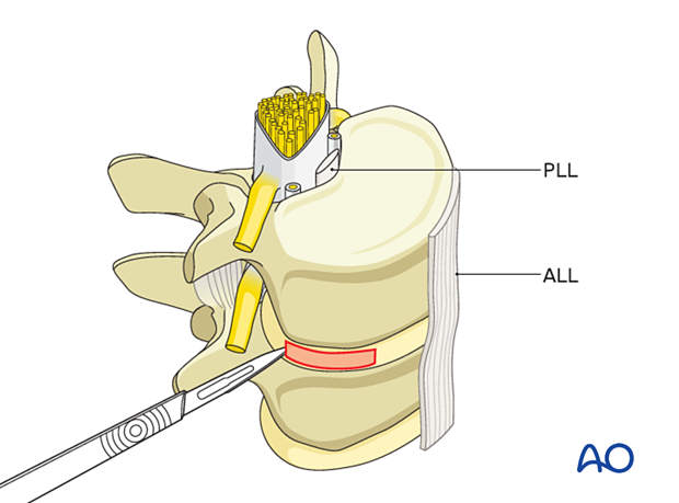 During Lateral lumbar interbody fusion (LLIF), the annulus is opened in a small square