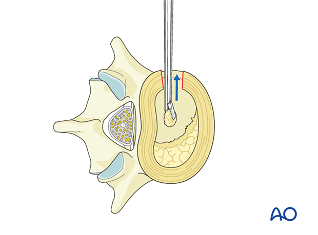 During Lateral lumbar interbody fusion (LLIF), a pituitary punch is used for enucleation