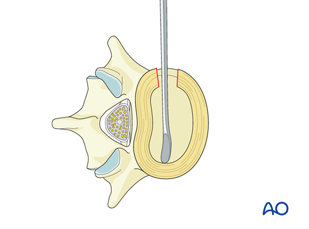 During Lateral lumbar interbody fusion (LLIF), a Cobb elevator is used to reach the contralateral annulus