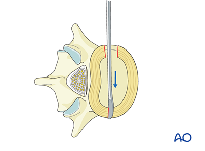 Lateral lumbar interbody fusion (LLIF) for Degenerative spondylolisthesis