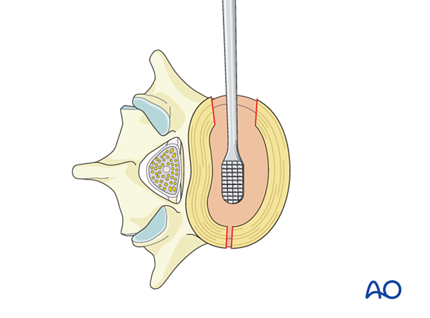 A standard preparation of the disc space is performed during Lateral lumbar interbody fusion (LLIF) 