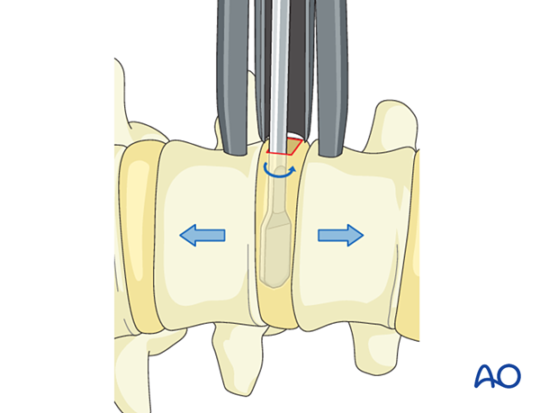 The disc space is gently distracted during Lateral lumbar interbody fusion (LLIF)