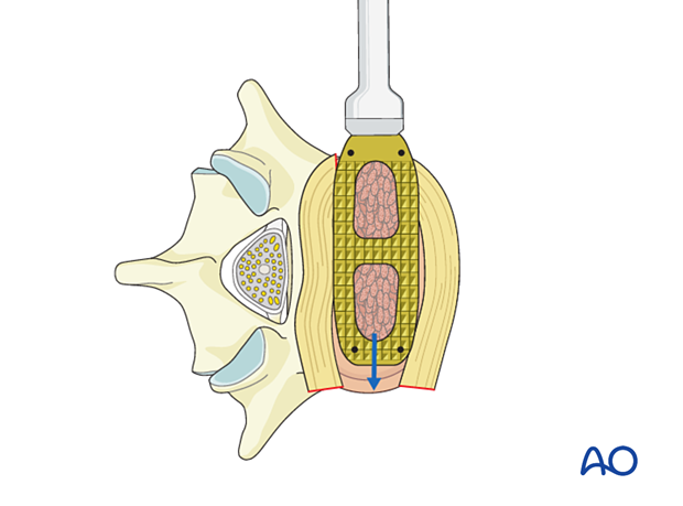 Insertion of the cage during Lateral lumbar interbody fusion (LLIF)