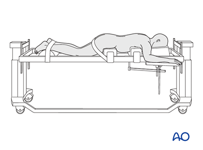 MISS Transforaminal lumbar interbody fusion (TLIF) for Degenerative ...