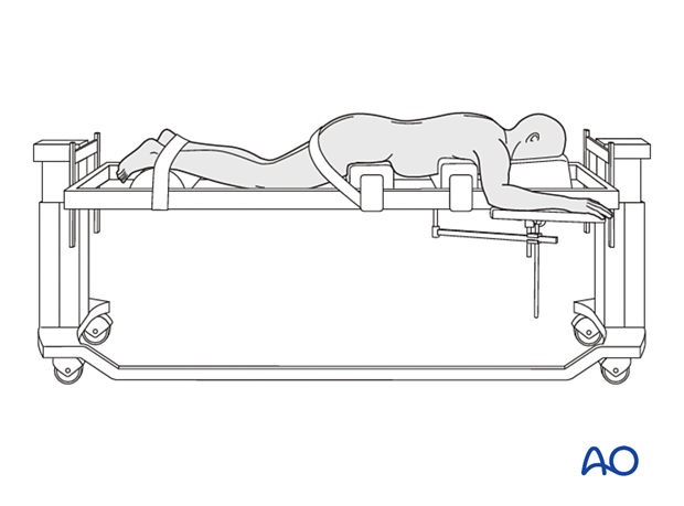 Patient in a prone position for MISS Transforaminal lumbar interbody fusion (TLIF)