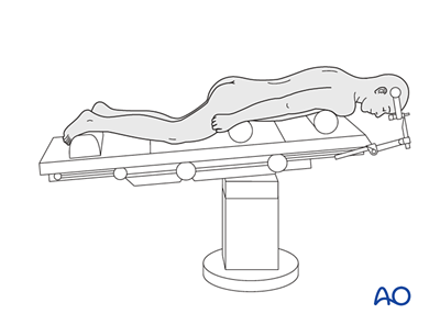 Prone position for approaches to C0–C7