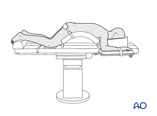 Patient in a prone position for approaches to C0–C7