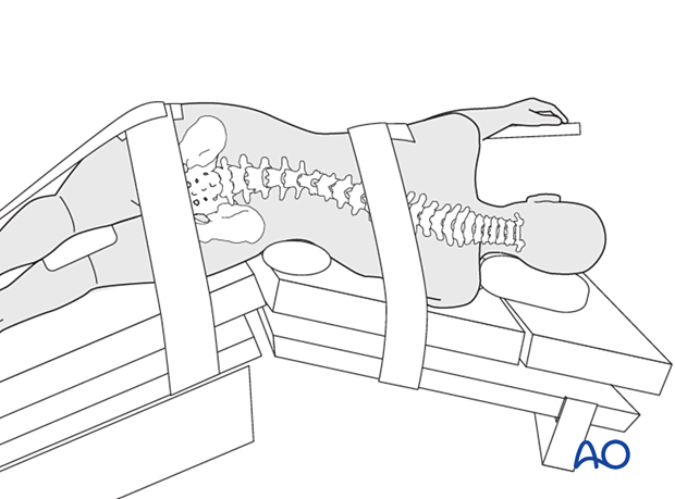 The iliac crest should be positioned just over the table break in the Lateral decubitus position for Lateral lumbar interbody fusion (LLIF).