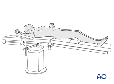 Supine position for Anterior lumbar interbody fusion (ALIF)