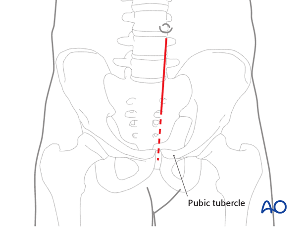 approach to the pubic symphysis