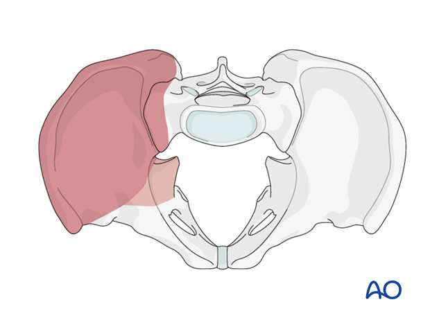 anterior approach to the iliac wing and si joint