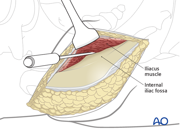 anterior approach to the iliac wing and si joint