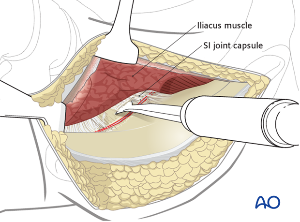 anterior approach to the iliac wing and si joint
