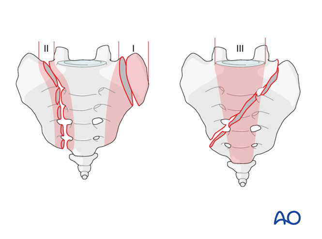 Posterior approach to the sacrum