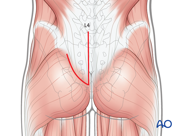 posterior approach to the sacrum