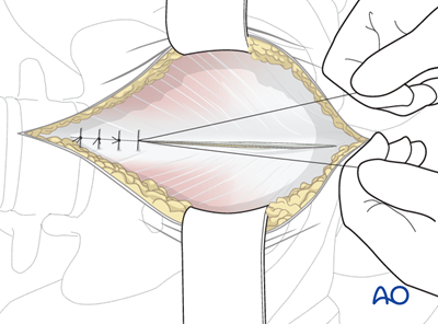 Modified stoppa to the anterior intrapelvic region