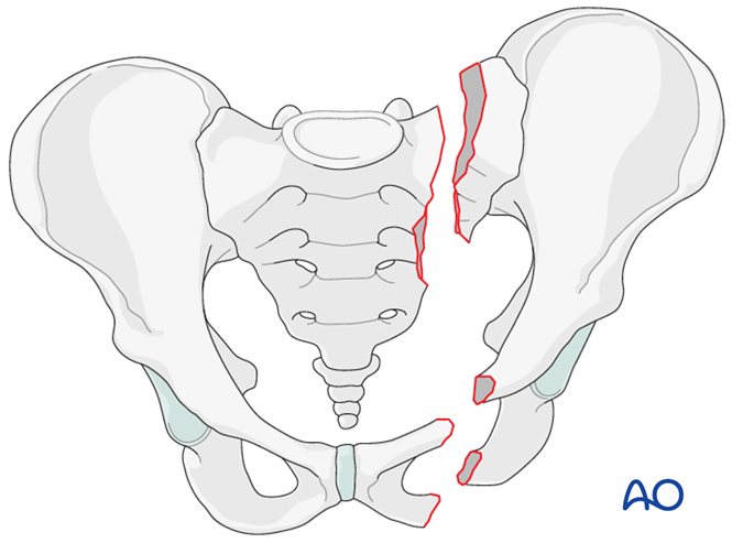 Pubic symphysis fractures