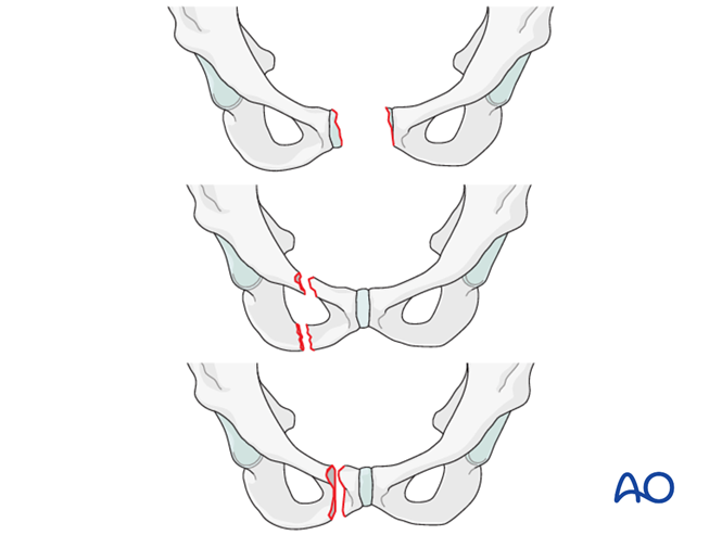 Arch Injuries Incomplete disruption of posterior arch, bilateral injury