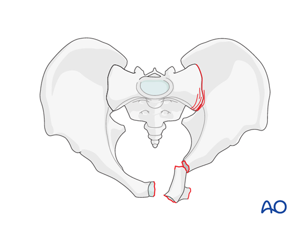 Operative treatment for Incomplete disruption of posterior arch ...