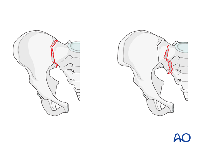 Incomplete disruption of posterior arch, bilateral injury
