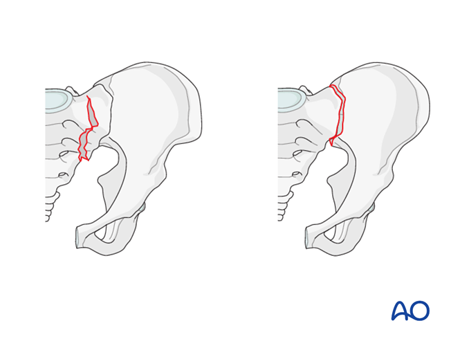 Arch Injuries Incomplete disruption of posterior arch, bilateral injury