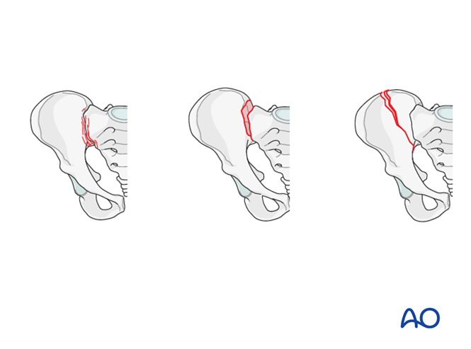 Arch Injury Incomplete disruption of posterior arch, bilateral injury