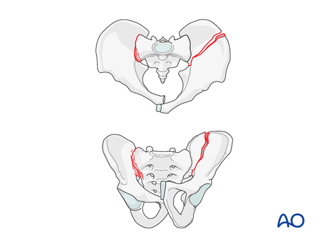 Incomplete disruption of posterior arch, bilateral injury