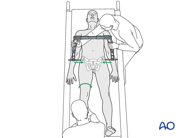 external fixation emergency stabilization with a c clamp