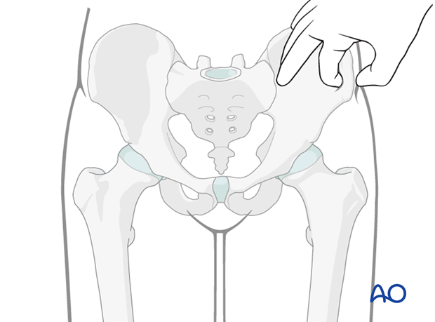 external fixation