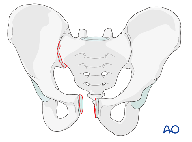 ORIF - Pubic symphysis plate for Pubic symphysis fractures