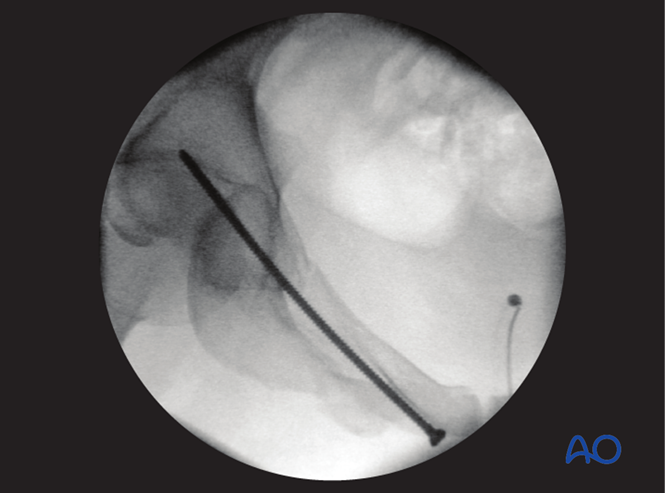 ORIF - Pubic ramus screw for Pubic ramus fractures