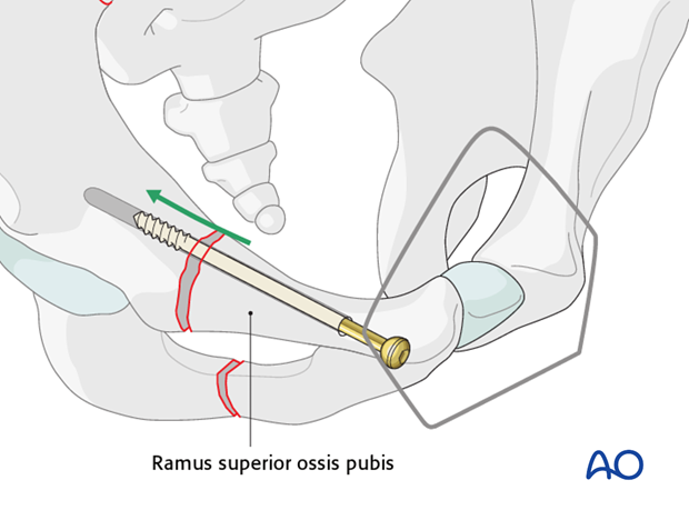 orif pubic ramus screw