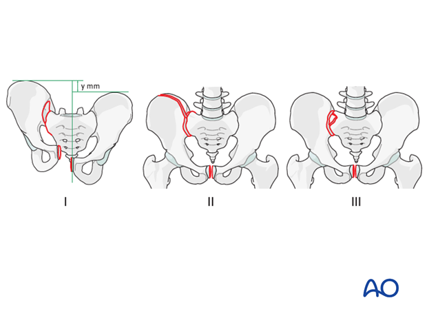 orif anterior si fracture fixation