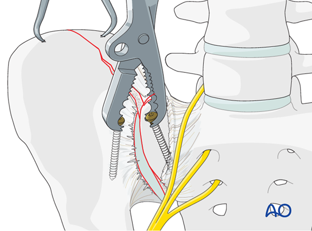 orif anterior si fracture fixation