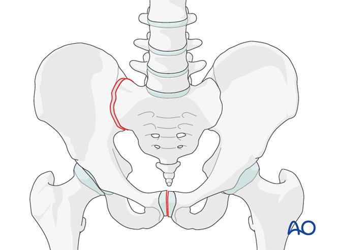 Anterior ORIF SI Joint