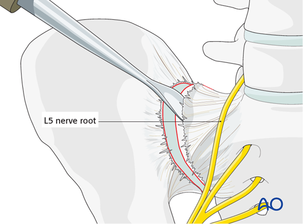 orif anterior fixation si joint