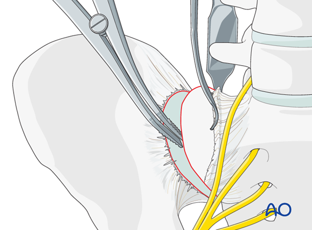 orif anterior fixation si joint