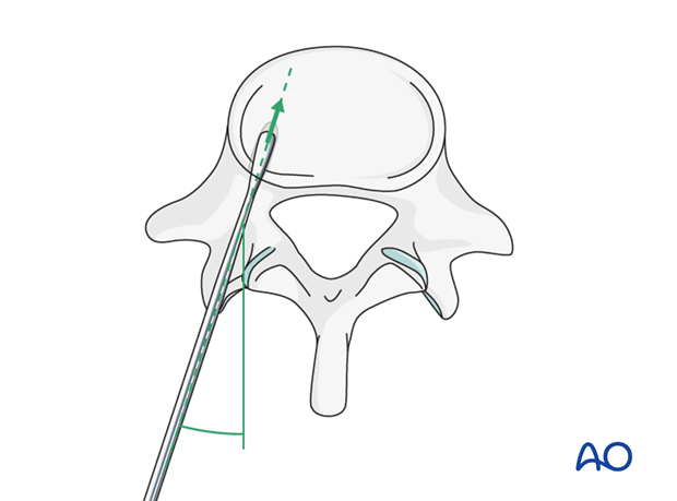 orif triangular osteosynthesis