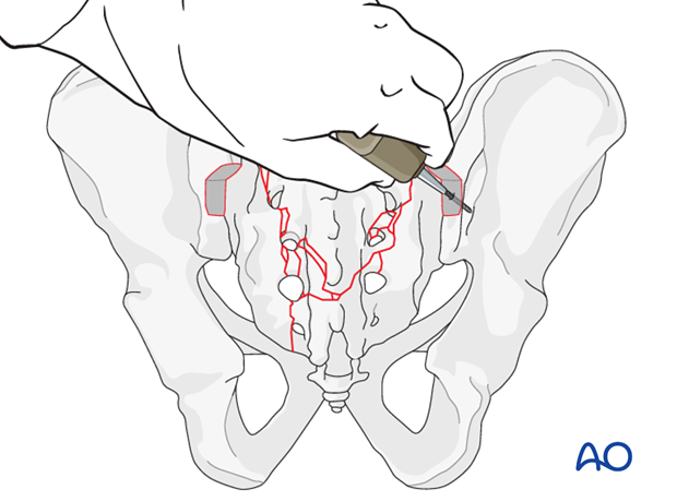 orif spinopelvic fixation