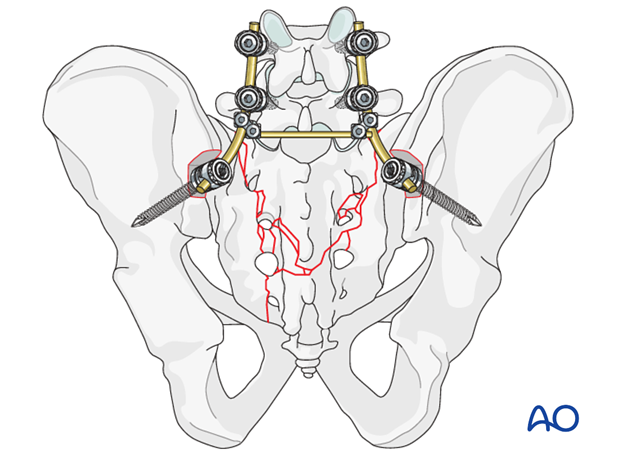 orif spinopelvic fixation