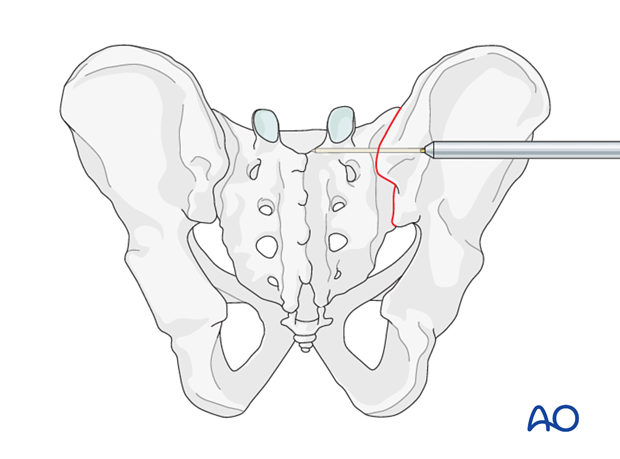 mio iliosacral screw navigation