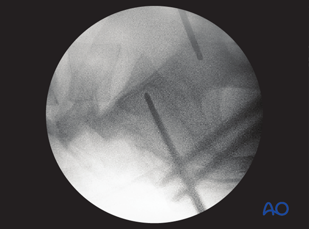 mio iliosacral screw for sacrum