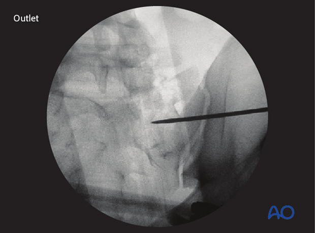 mio iliosacral screw for sacrum