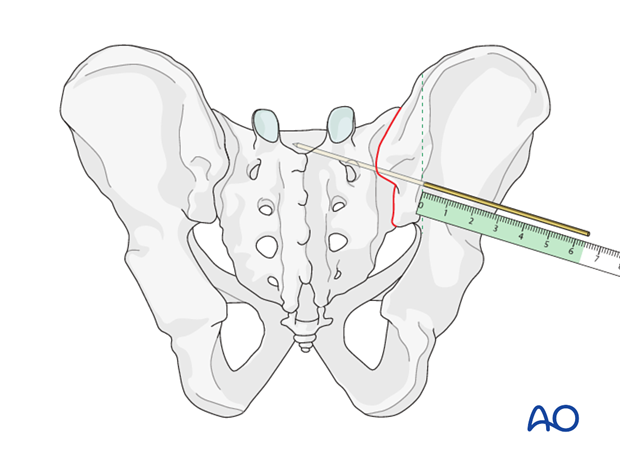 mio iliosacral screw for sacrum