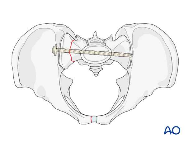 mio iliosacral screw for sacrum