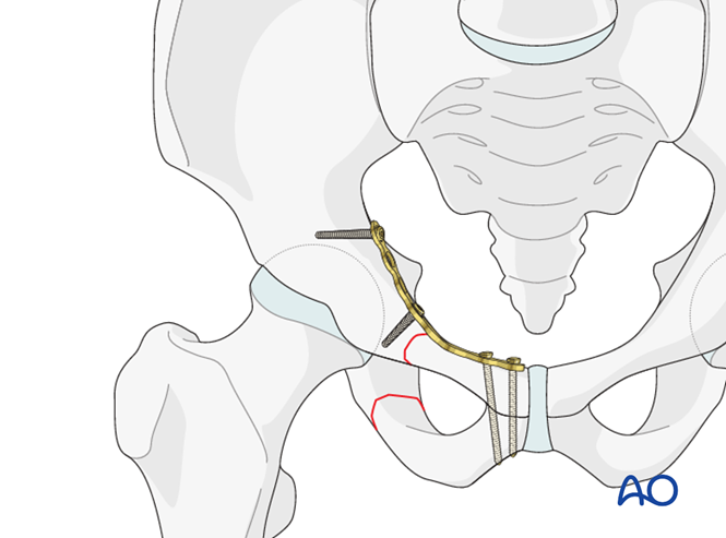 ORIF - Pubic ramus plate for Intact posterior arch, uni- or bilateral ...